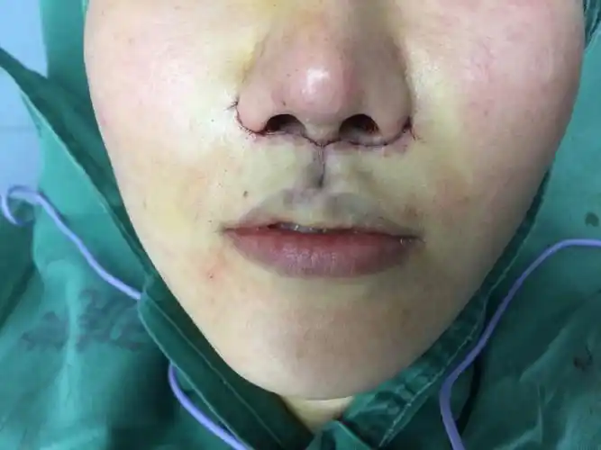 人中缩短是可以大妈变少女的减龄手术,于是我也来_圈子-新氧美容整形