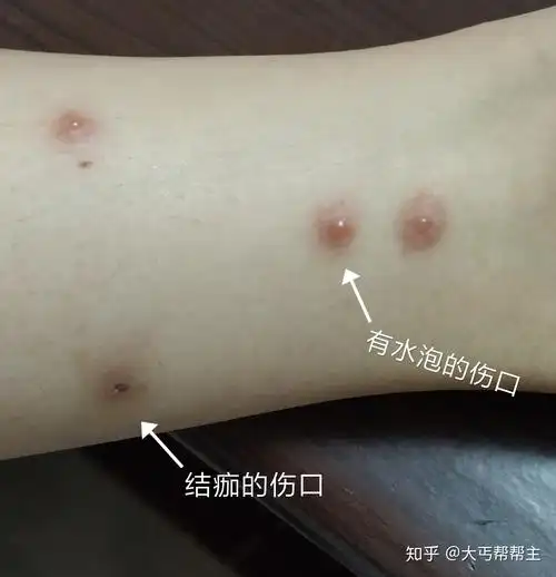 被狗虱子咬的悲惨经历