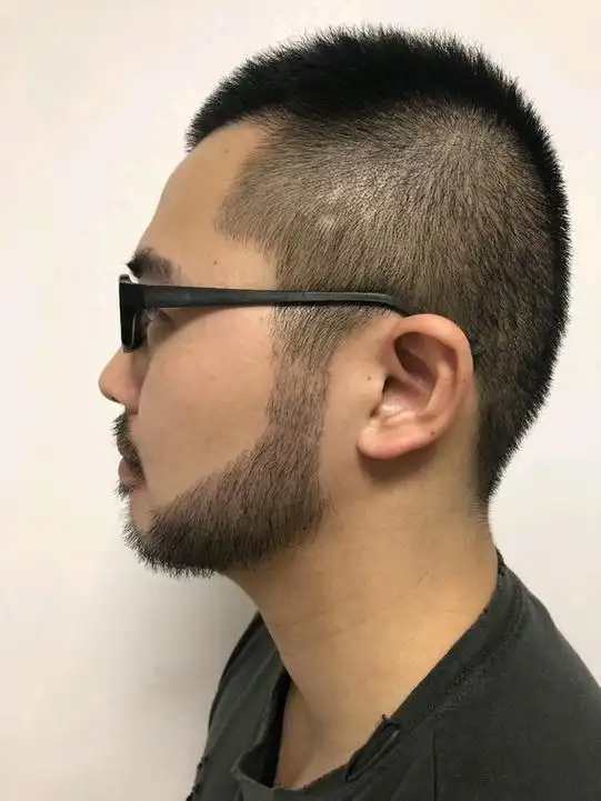 男士胡须鬓角种植案例#有人看得出来这是种植的胡须_圈子-新氧美容