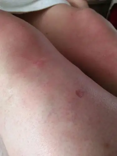 静脉曲张,滑膜炎患者体验补光仪