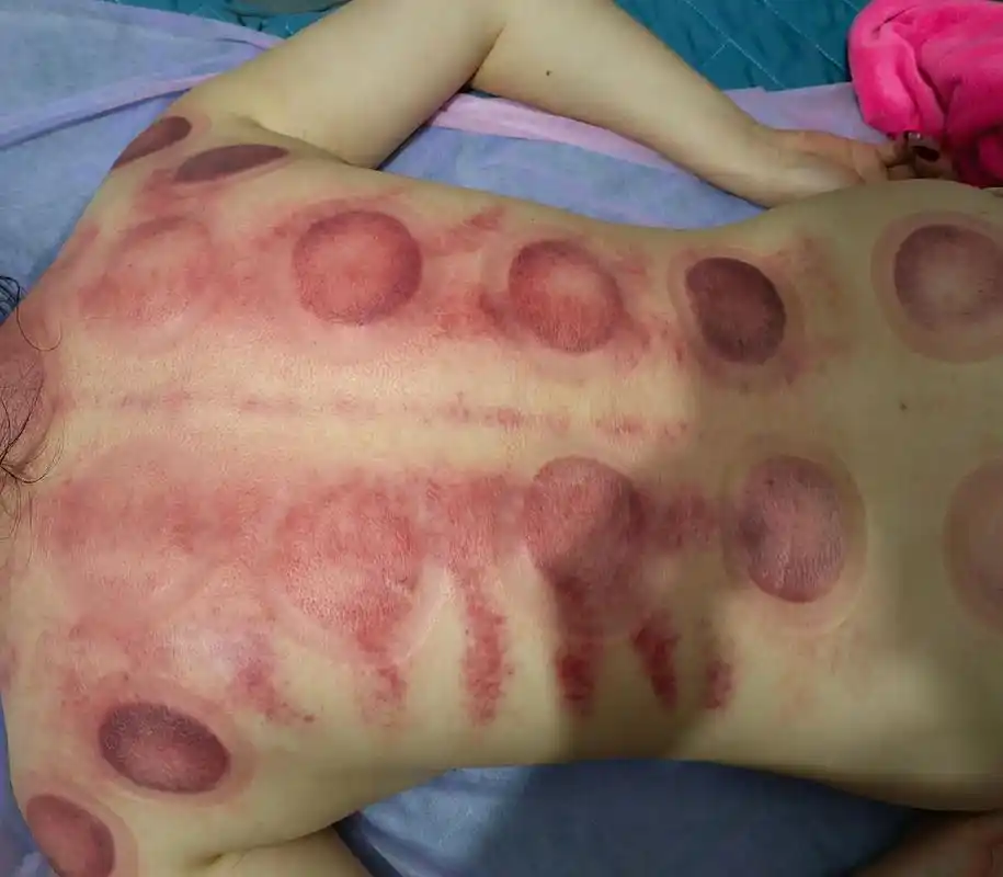 拔罐的好处和作用