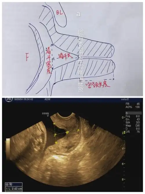 如何测量宫颈漏斗宫颈长度?