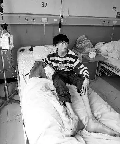 男孩患怪病身似蜘蛛人 四肢细长不匀称