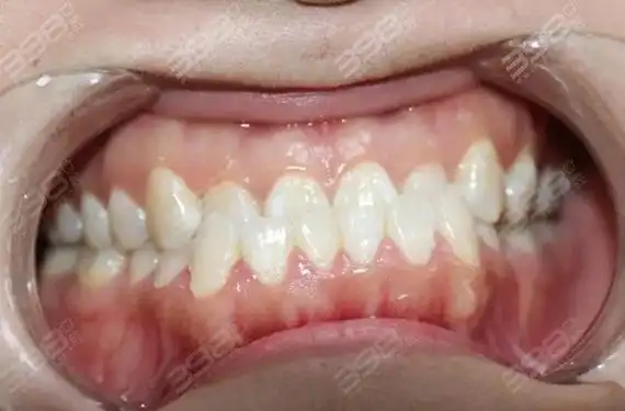 地包天怎么算严重 地包天严重程度分几种