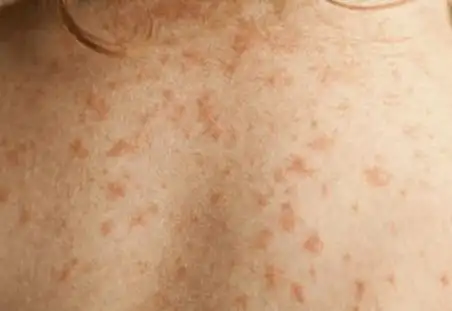 螨虫咬的包是啥样子,被螨虫咬的症状图片