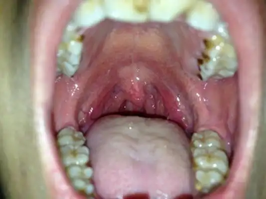 扁桃体癌图 (17)_有来医生
