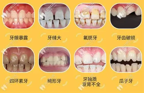 牙龈暴露,牙缝大,氟斑牙,牙齿破损,四环素牙,畸形牙,牙釉质发育不全