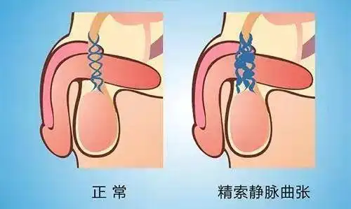 男性不育的杀手"精索静脉曲张",早发现早治疗|睾丸|手术_网易新闻