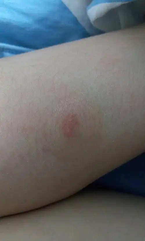 痒了好几天了,今年夏天和九月份螨虫全是,但后来经过杀虫处理,我觉得