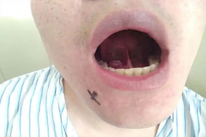 单纯型舌根囊肿图