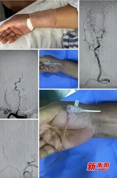 神经介入新通路 常宁市人民医院开展经桡动脉入路全脑血管造影