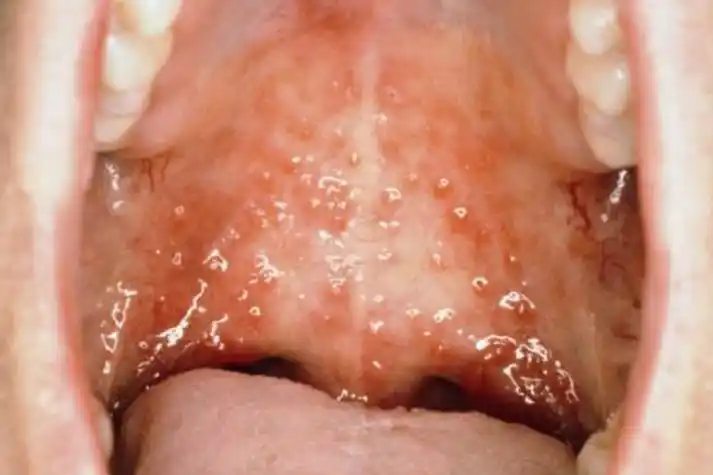 疱疹性口腔炎图