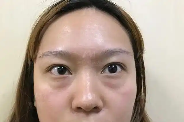 用这个方法快速去眼袋!