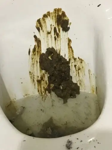 排便不成型最近发现排便是黑色的而且沾便池 排便不成型有俩个多月了
