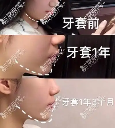 骨性凸嘴和齿性凸嘴区别对比,如何区分凸嘴是骨性还是牙性!