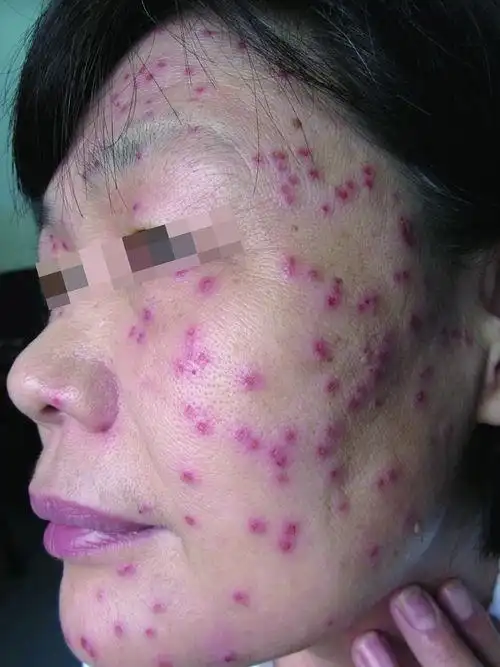 被螨虫咬的症状图片