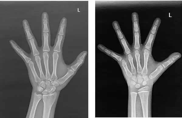 1米55杭州14岁男孩再也长不高妈妈追悔莫及医生有些老话信不得