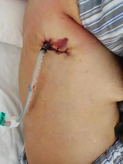 伤口照片.jpg