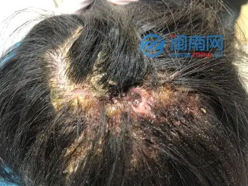 惊死人泉州一女子头皮痒了3个月竟从头皮内取出6只蛆