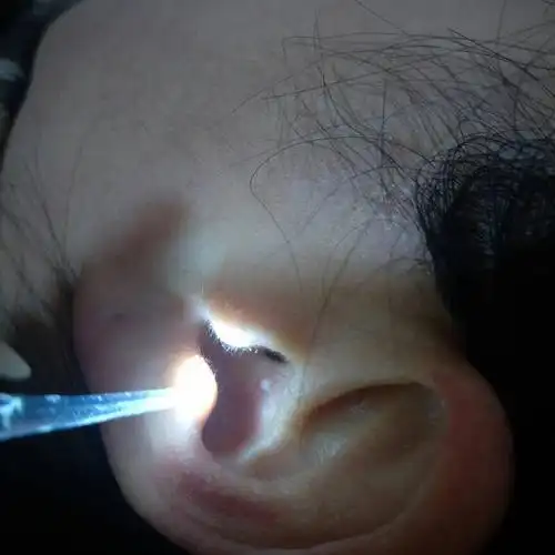 妈妈耳朵里长个白色圆粒,有知道是什么的么