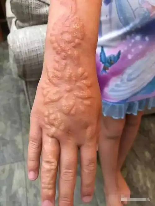 模仿印度新娘画"临时纹身"造成终身伤害 小伙痛不欲生