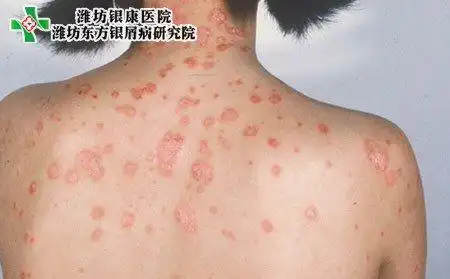 潍坊银康 银屑病常识    潍坊银康医院表示,与牛皮癣患者接触可以放心