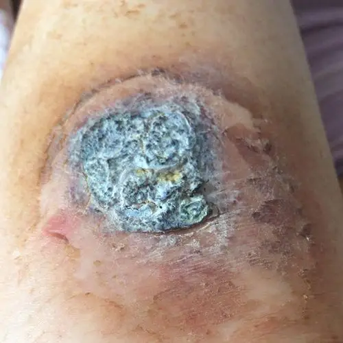 发霉的皮肤tips:皮肤长霉表现为:皮肤水淋淋的,一圈一圈开始烂.