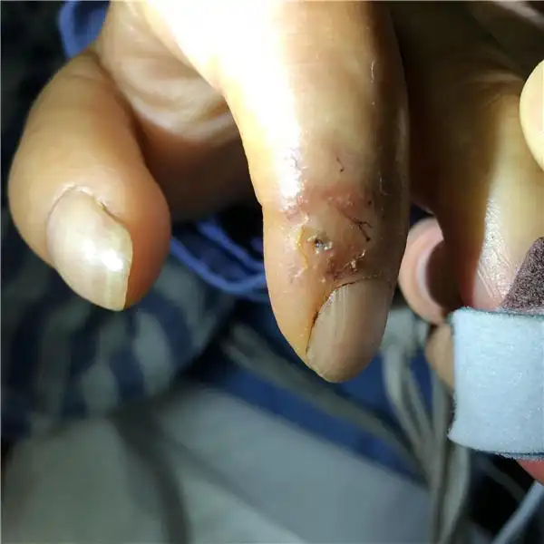 串串竹签扎进手指 10多天后65岁四川老人感染破伤风病危