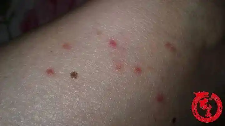 半月前飞来一种小黑虫,全楼居民都挨咬,有人一天被叮30多个包,到底哪