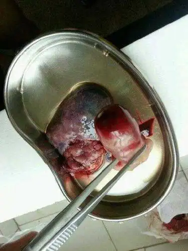 过了14周之后到28周之内的胎儿,终止妊娠的主要方式是妊娠中期引产术.