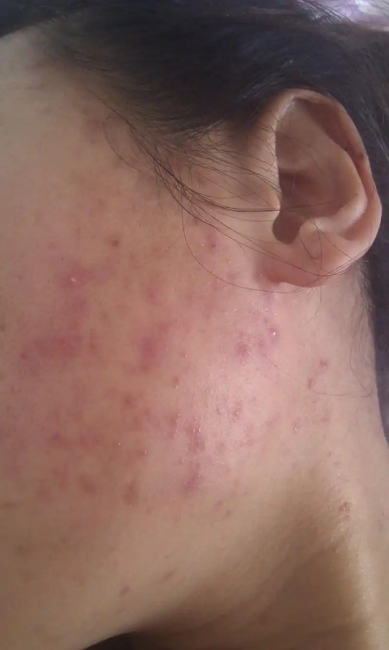 脸颊突然起红色痘痘但是不疼不痒是什么痘痘啊