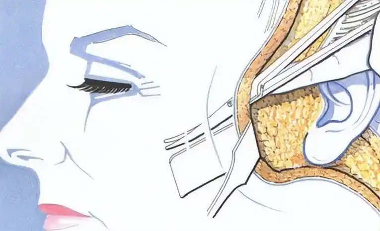 老阿姨的疑问50岁拉皮手术能维持几年,拉皮手术能做几次~_面部_皮肤