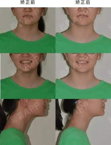 矫正前后面像对比