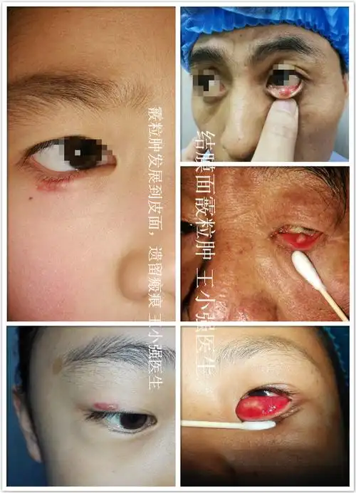 霰粒肿的不同类型表现及其手术方法附外观及手术图片