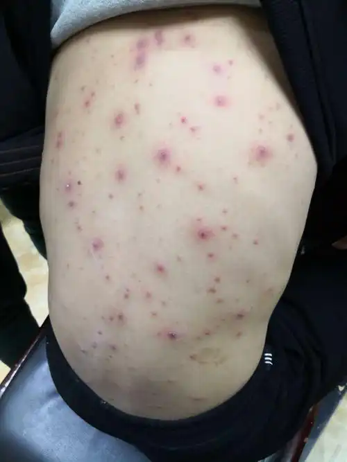 中药治疗水痘,手足口病并发的案例