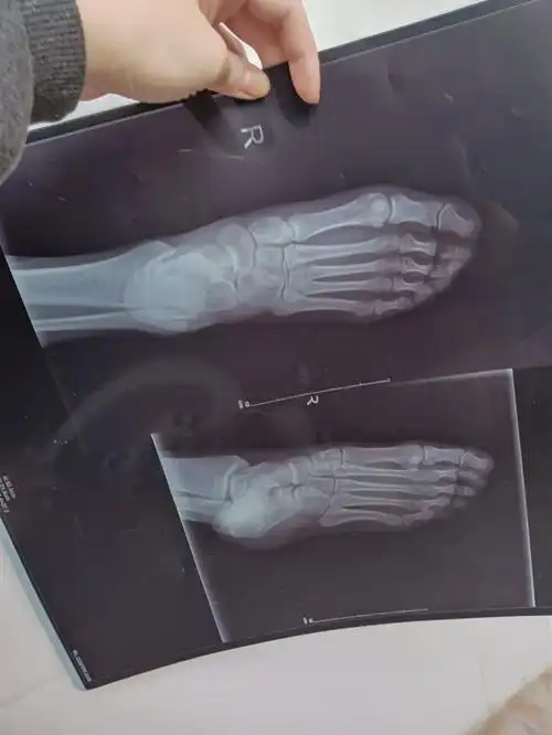 x光拍片不会看,有的骨又们说我是lisfranc,搞到心怕怕到时去拍ct,脚板