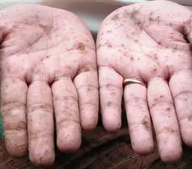 重金属中毒【多图】_39医疗图集-39健康网