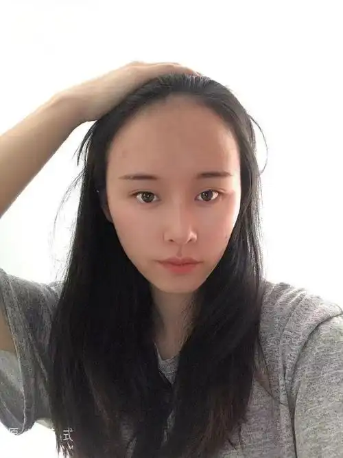 下图是庞女士发际线种植前后的对比,改善之后效果很不错,大家可以参考