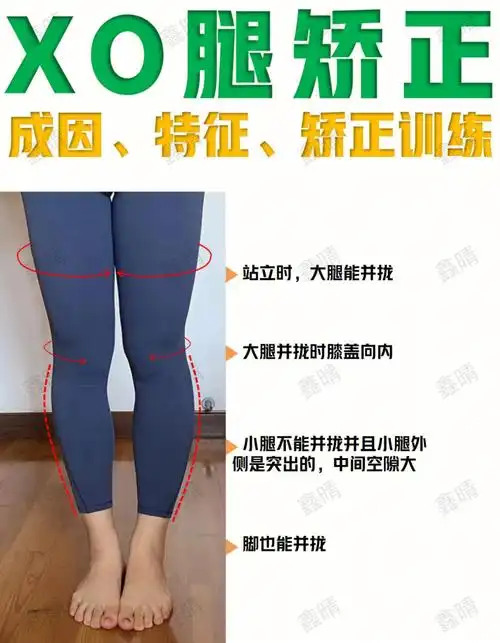 xo腿一个动作矫正练后1个月看效果