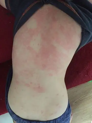 my-son-is-allergy 孩子过敏全身起红点痒怎么办? 育儿 身体健康