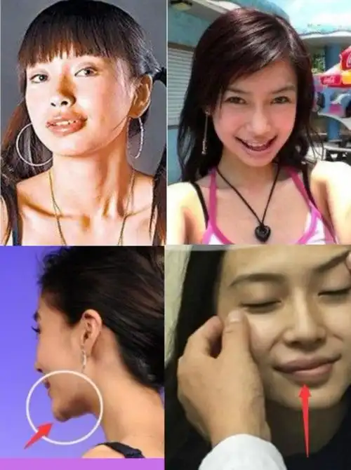 【案例分析:牙齿矫正可以整颌骨吗?她到底动了哪里变化这么大?】