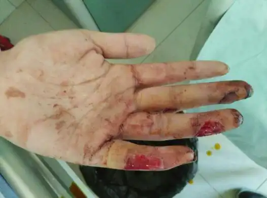 轻问各位法医 我这属于轻伤还是轻微伤,现在无名指和小拇指做了植皮