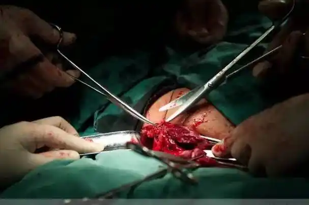 围观剖宫产这里有100张高清照片