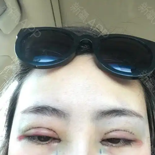 开内眼角好不好_效果图_kaka1117开内眼角术后第2天_新氧美容整形