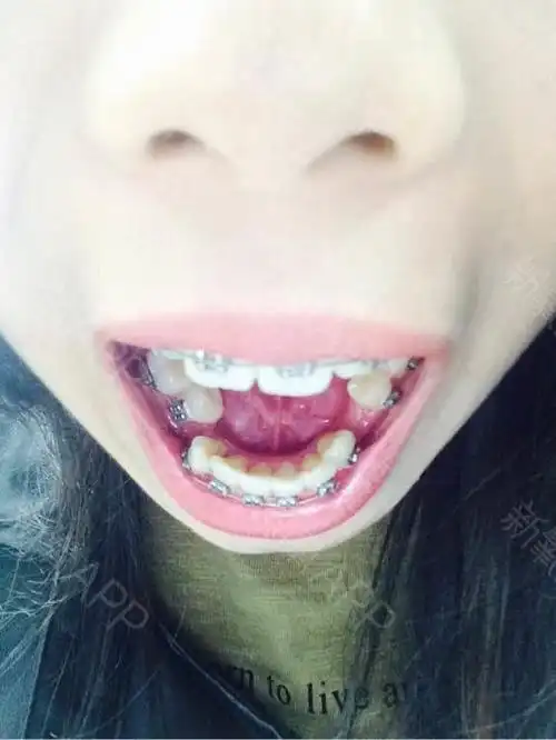 天生缺一颗侧切牙门牙偏歪左右不对称拔了三颗牙上面一_圈子-新氧美容