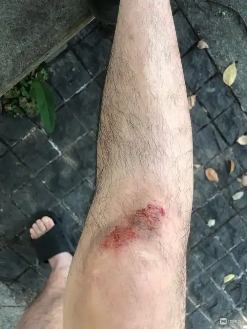 腿受伤了,擦什么药水好