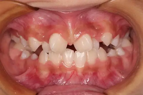 换牙期的牙齿不齐矫正1