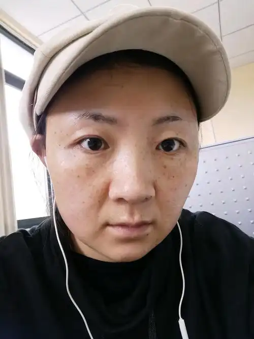 不知道是不是反黑,第二张是我做超皮秒前十天,刚洗完澡的状态