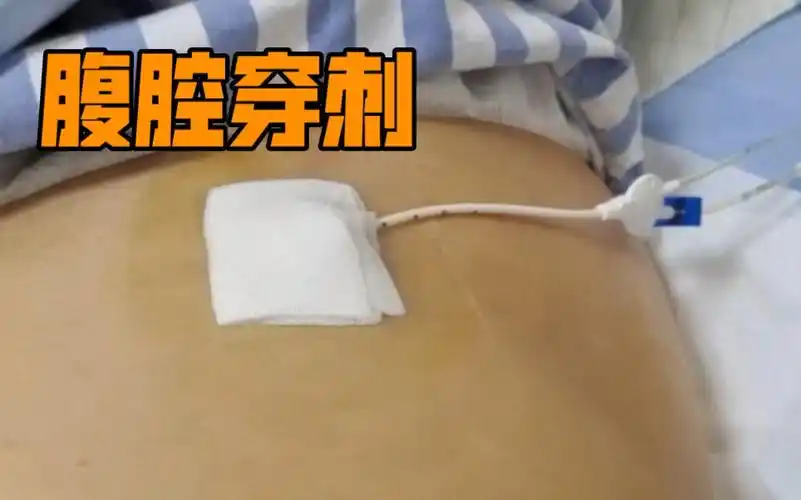 试管vlog|移植第12天,腹腔穿刺排积液,觉得自己很厉害惨了