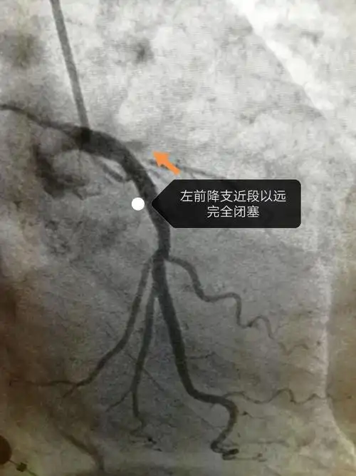 急诊冠脉造影示左前降支近段血栓形成并完全闭塞.